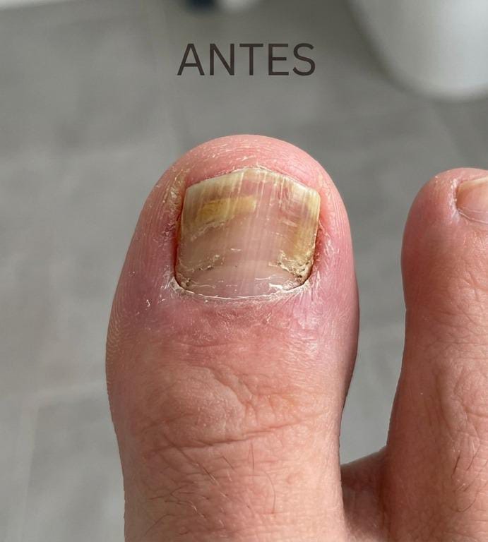 Procedimiento podológico en una uña del pie